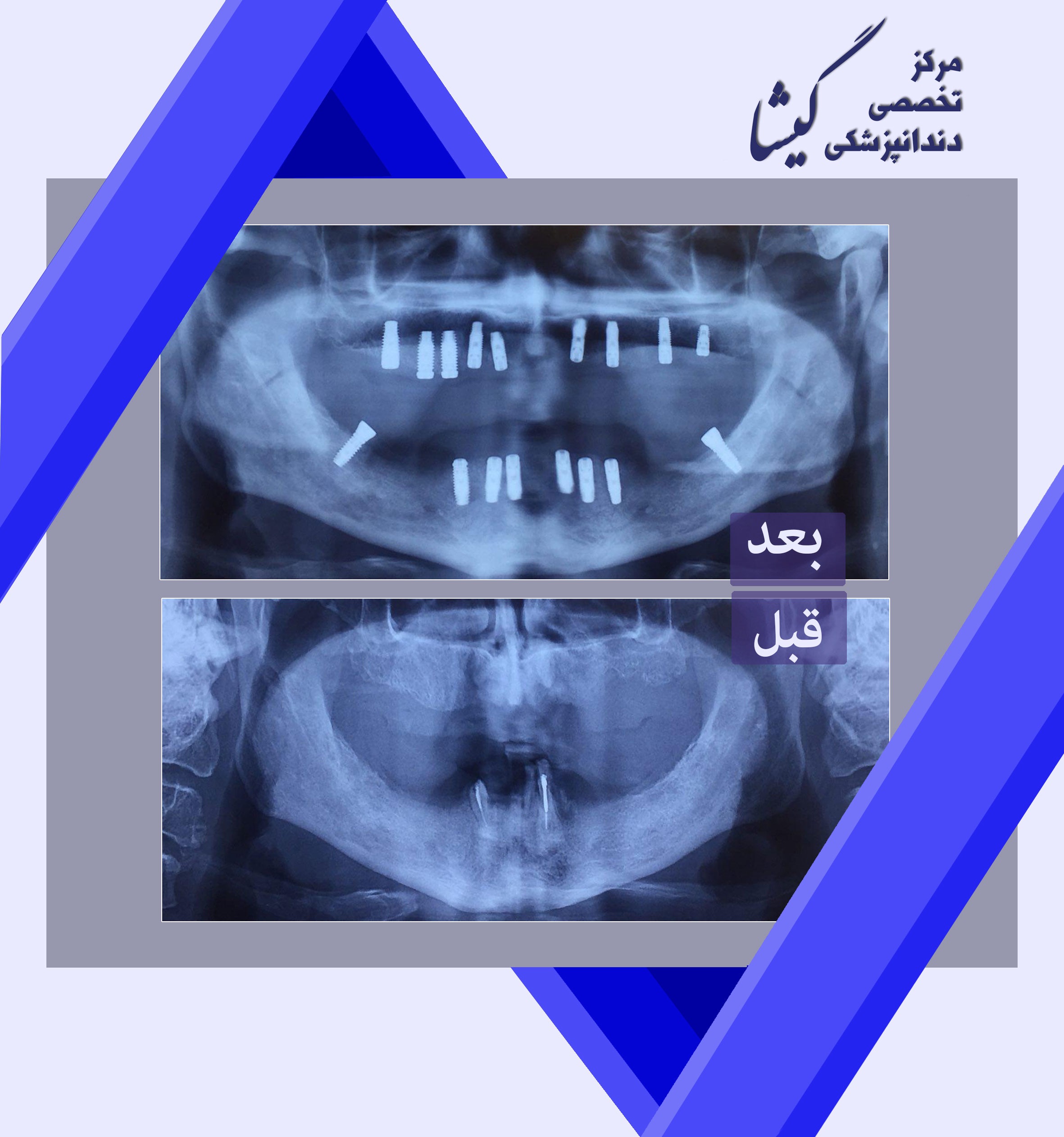 ۱۷ واحد ایمپلنت برای بیمار بیدندان کامل