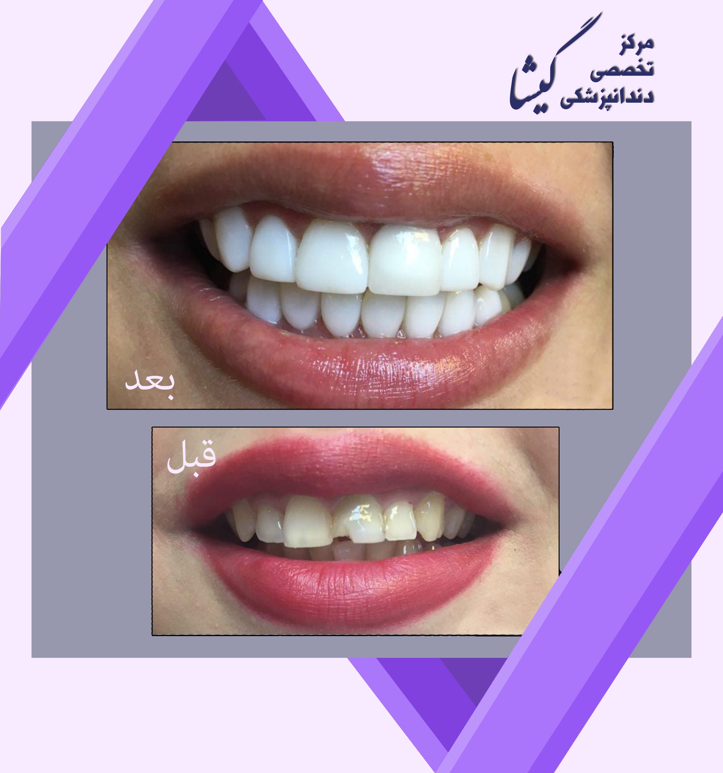 ونير كامپوزيت