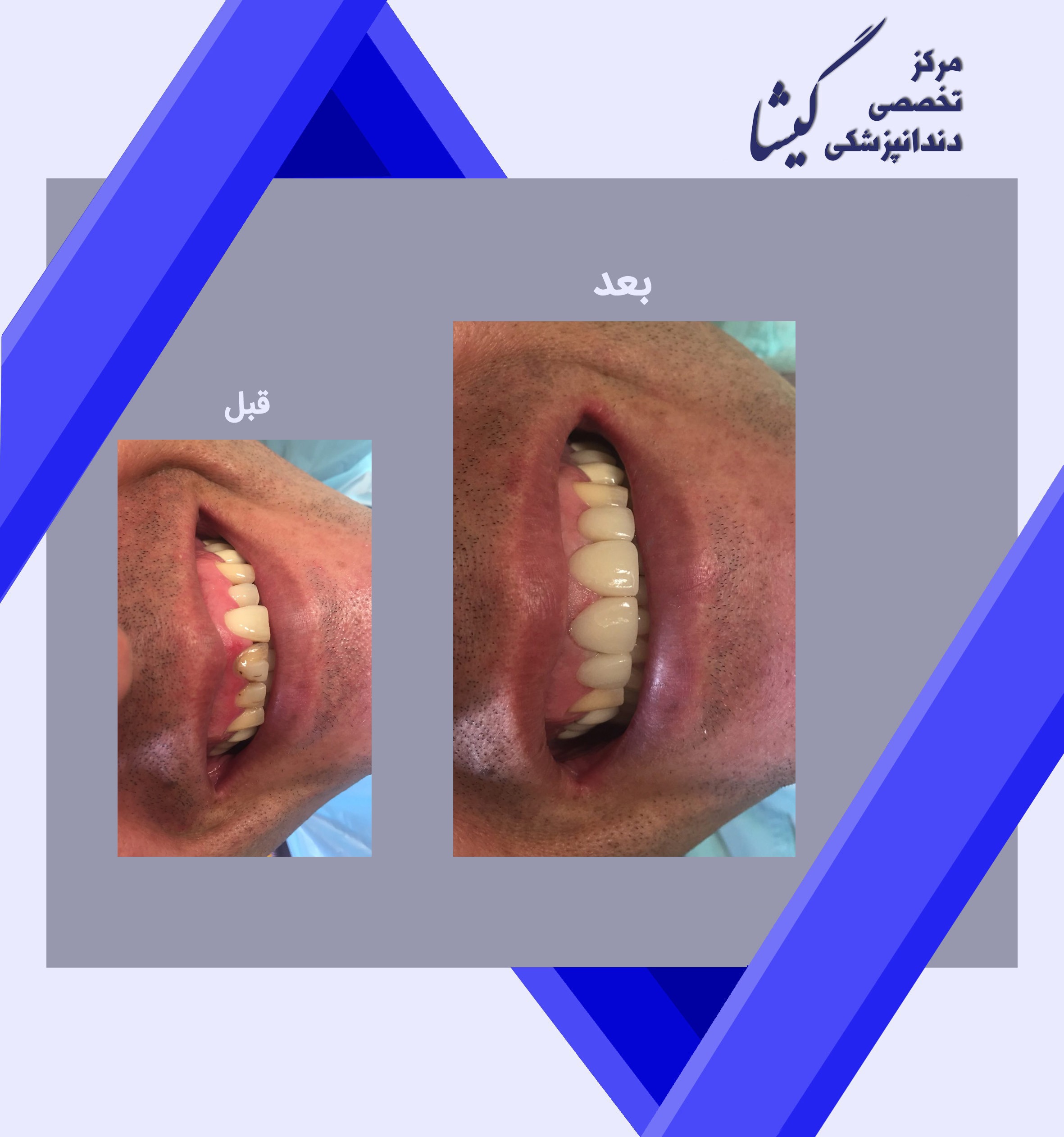 ۴ واحد روکش و لامینیت سرامیکی برای دندانهای جلو