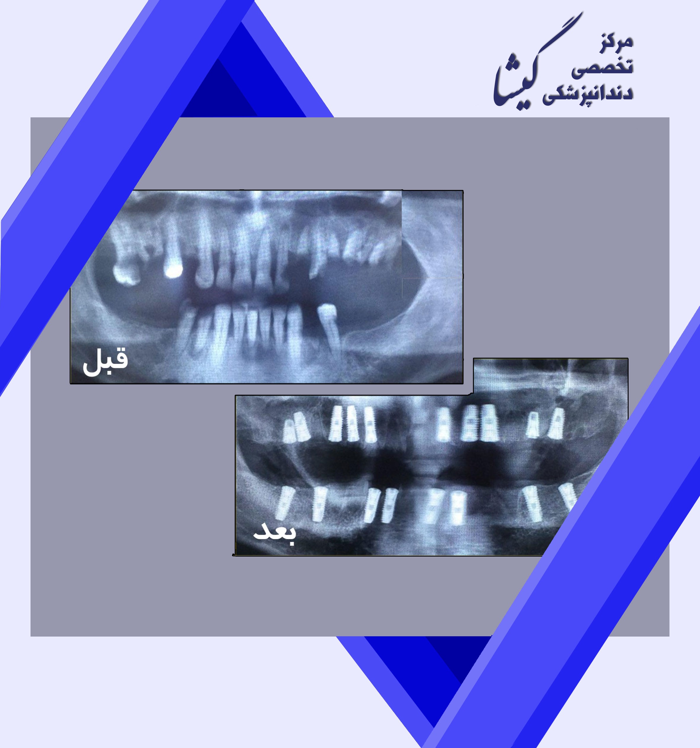 پیوند سینوس