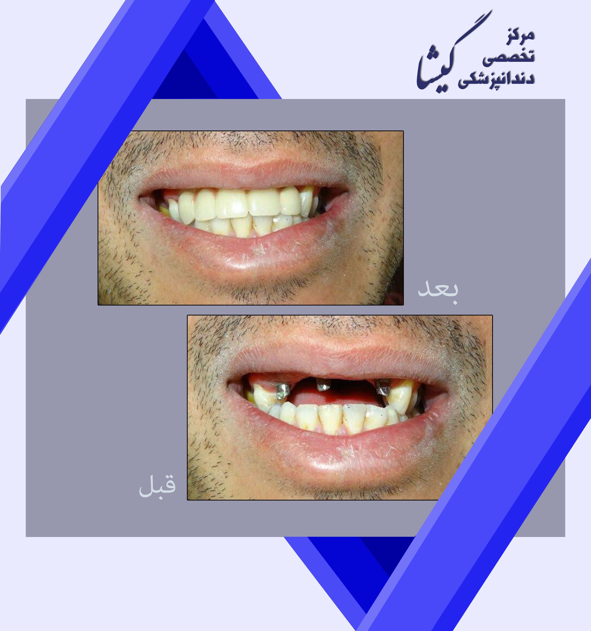 درمان ایمپلنت در بیمار 25 ساله