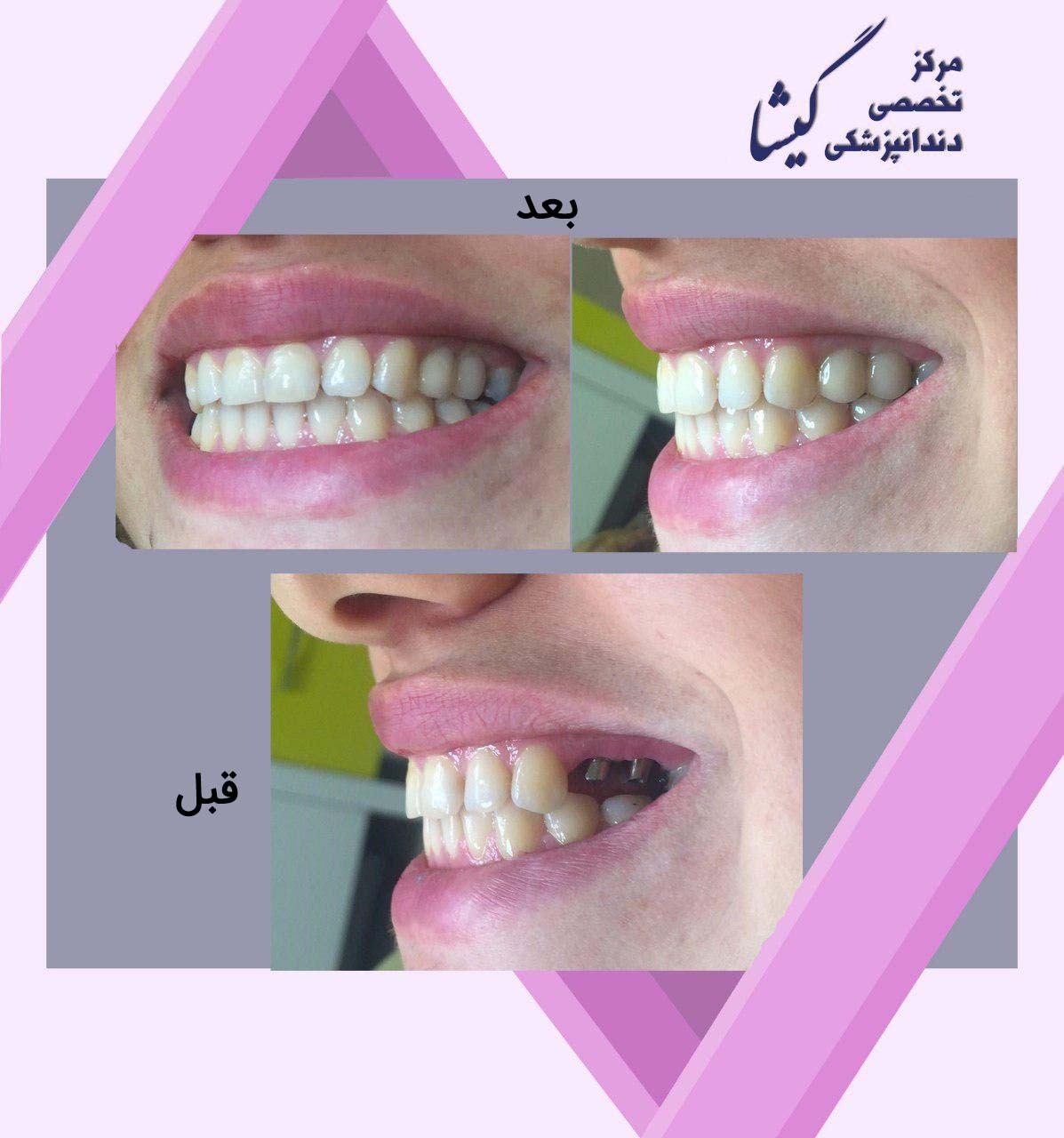 دو واحد روکش زیرکونیا متکی بر ایمپلنت