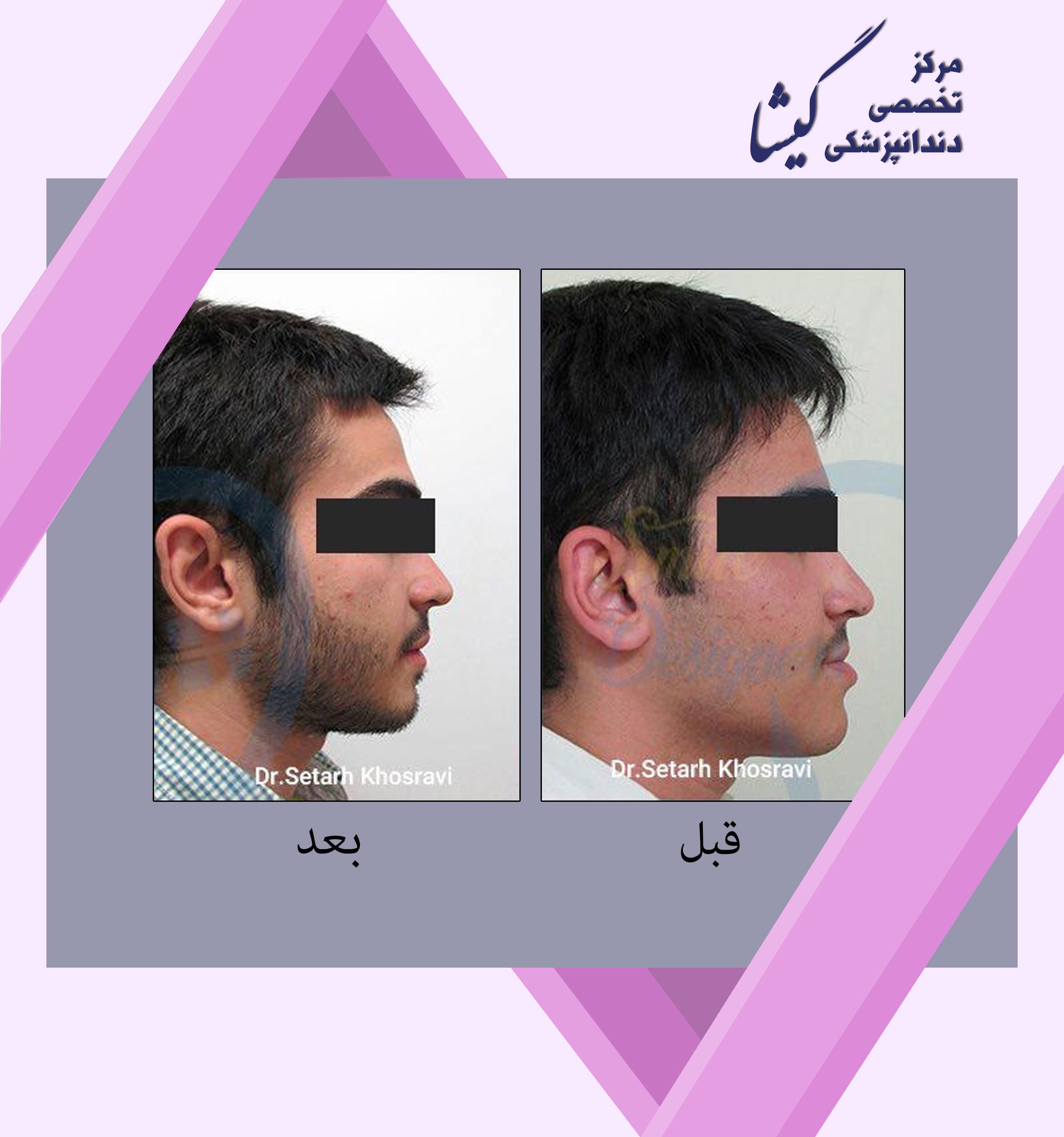 درمان بيمار١٩ ساله مبتلا به بزرگي فك پايين با جراحي فك و ارتودنسي .