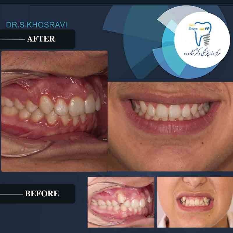 اجرای ارتودنسی ا جدیدترین متدهای روز