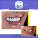 روکش تمام سرامیک دندانهای بالا  توسط متخصص پروتزهای دندانی و ایمپلنت( دکتر عزیز گشاده رو ، هیئت علمی دانشگاه شهید بهشتی ، رتبه اول بورد کشور)