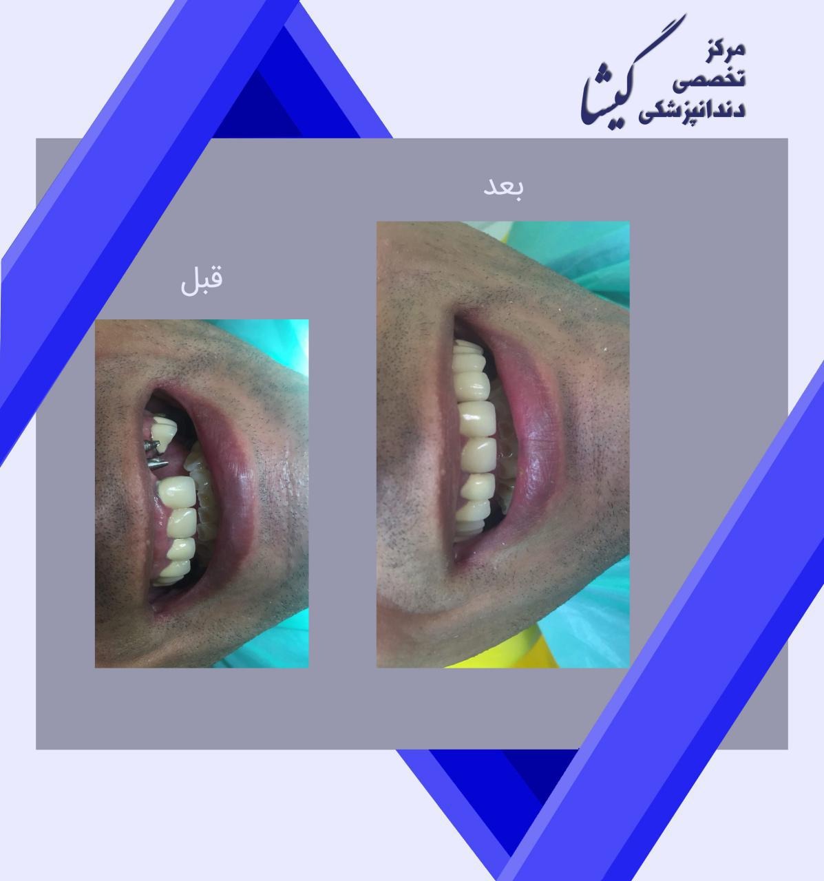 ایمپلنت دو دندان جلویی