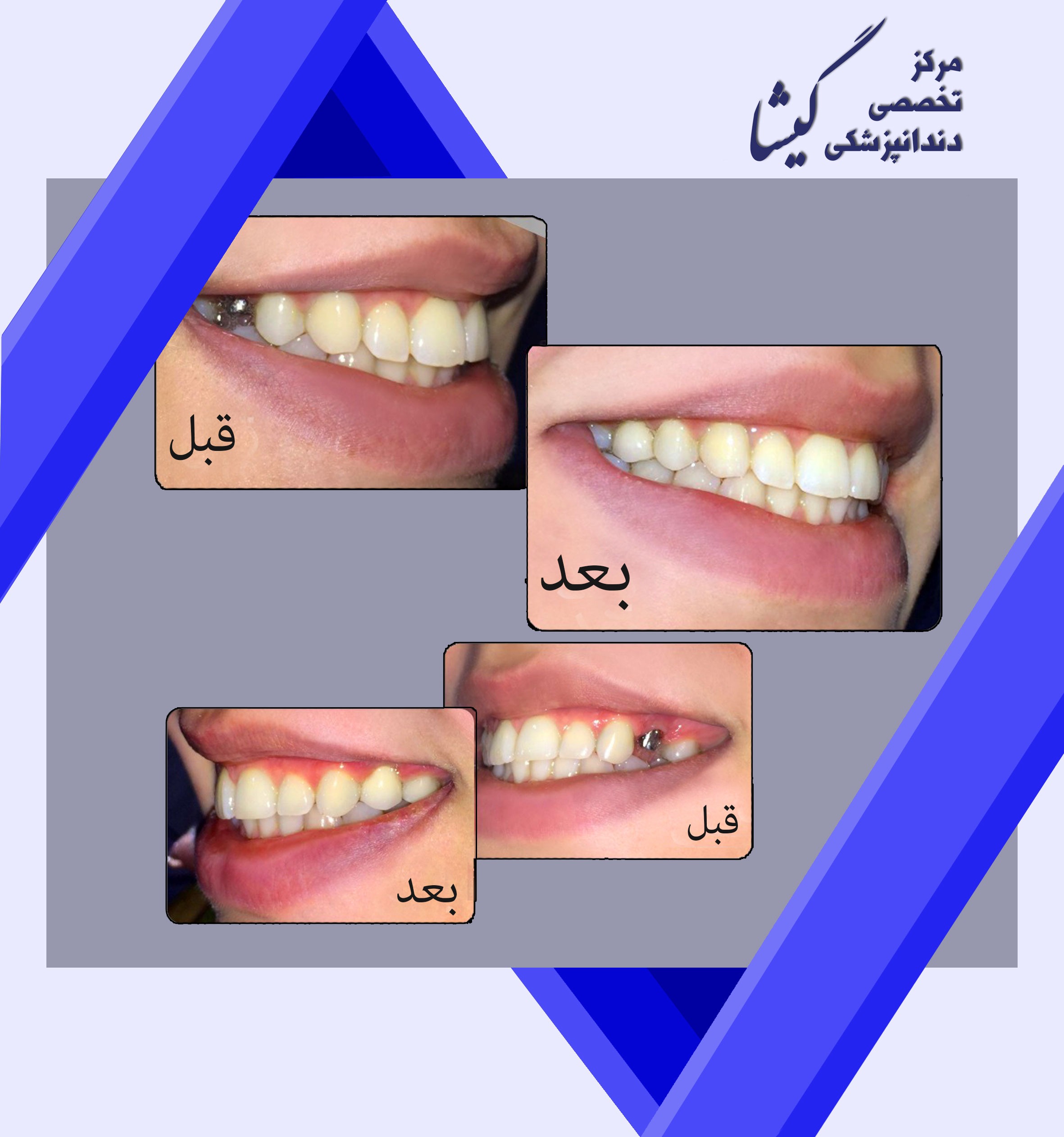 دو واحد ايمپلنت