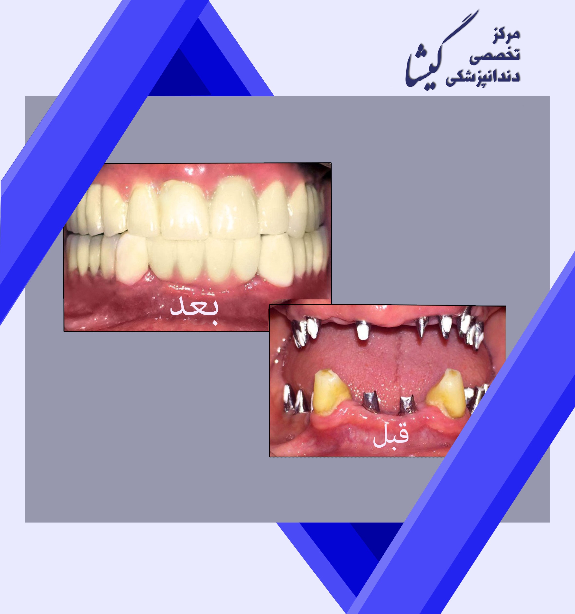 بازسازی دندان  ايمپلنت و روكش هاي تمام سراميك