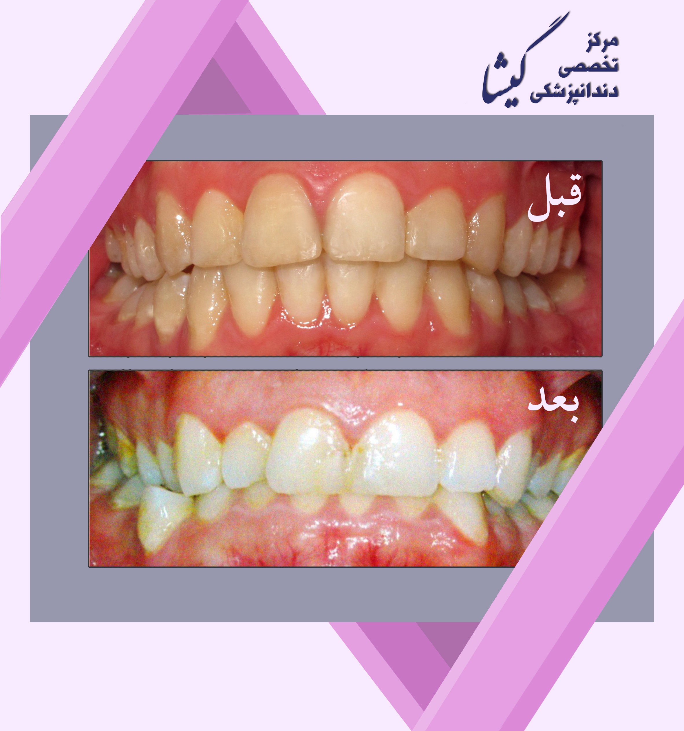 ميزان ديده شدن دندانها حين لبخند فاكتور مهمي در زيبايي است.