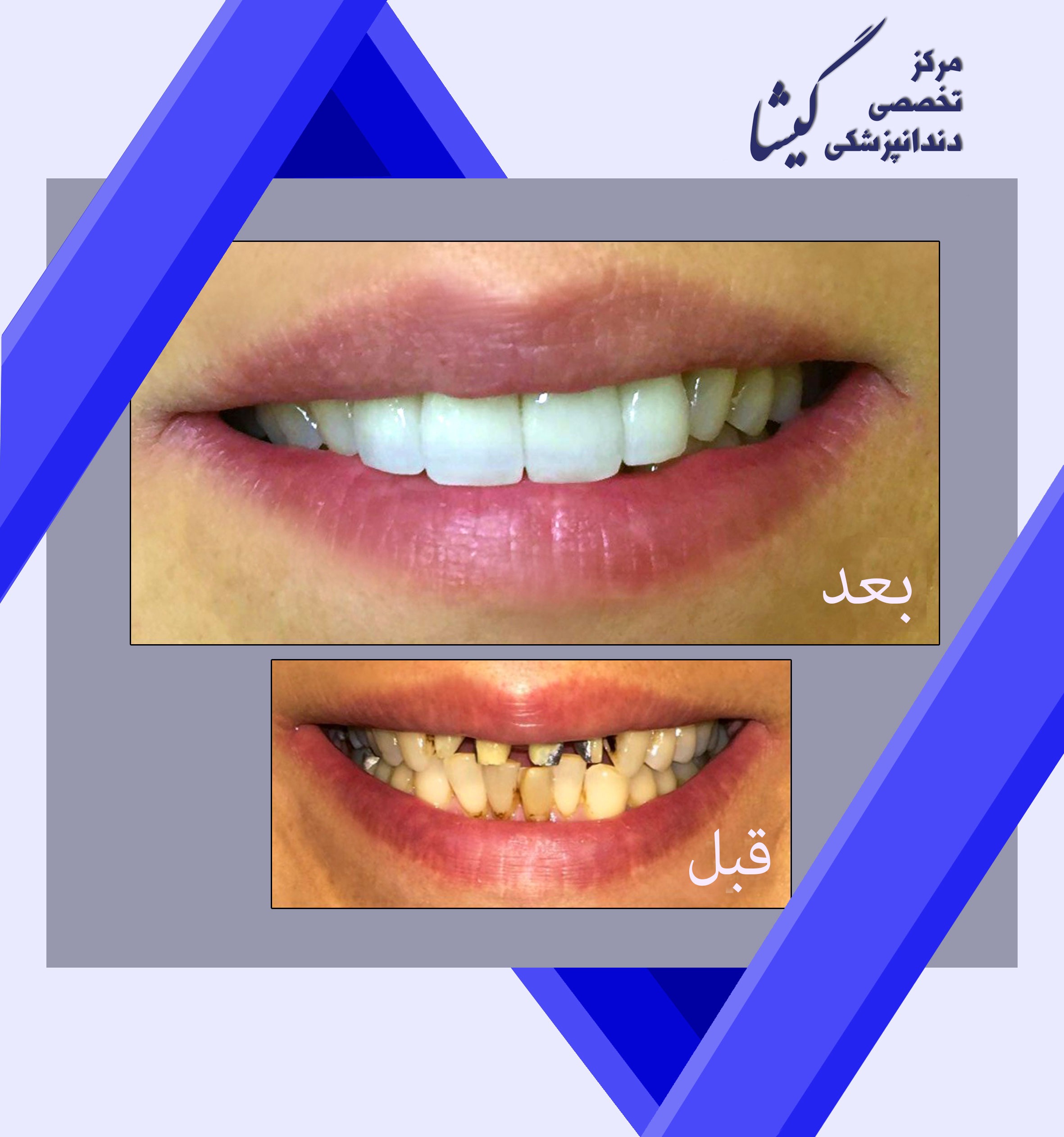 اصلاح طرح لبخند