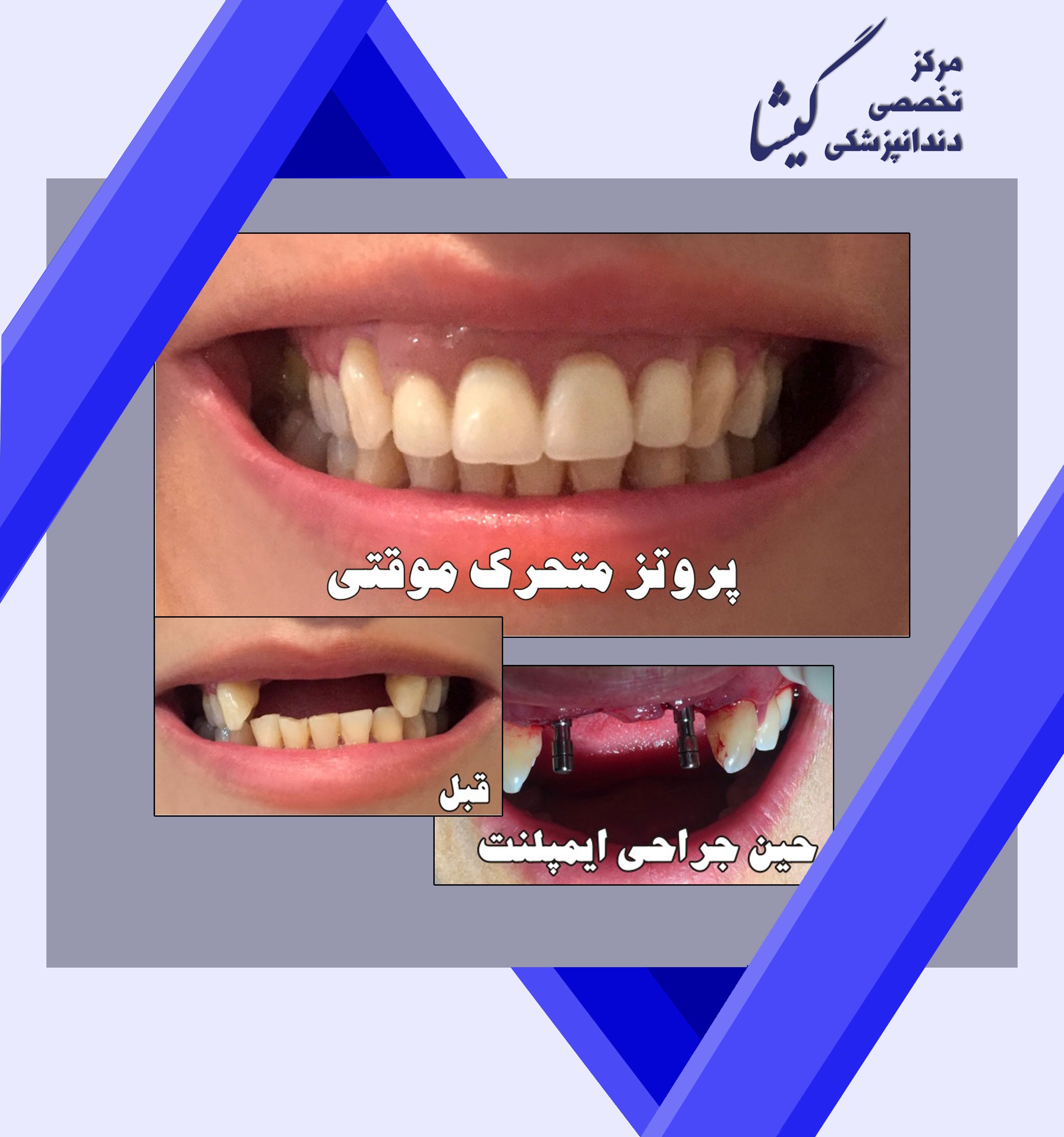 جایگزین کردن 4 دندان جلویی با استفاده از  دو عدد پایه ایمپلنت