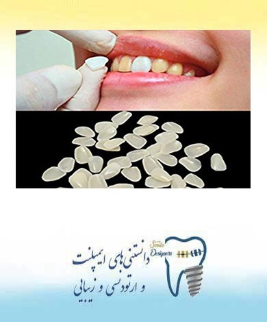 فواید لمینت خیلی نازک دندان