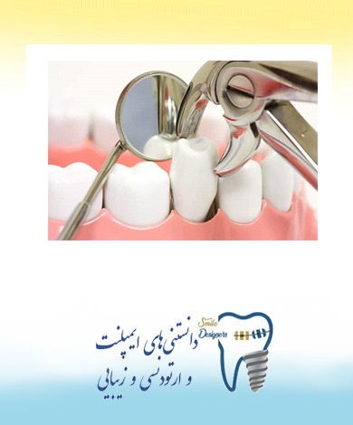 کشیدن دندان چگونه است؟آیا میتوان همزمان با کشیدن ایمپلنت کاشت؟