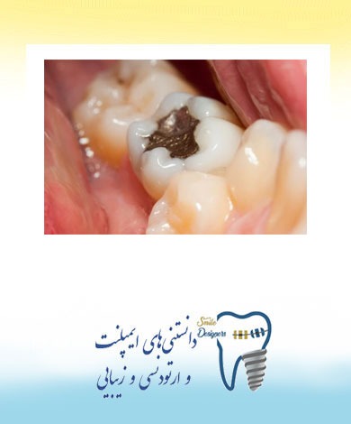 از کجا بدانیم باید پر شدگی دندان را عوض کنیم؟