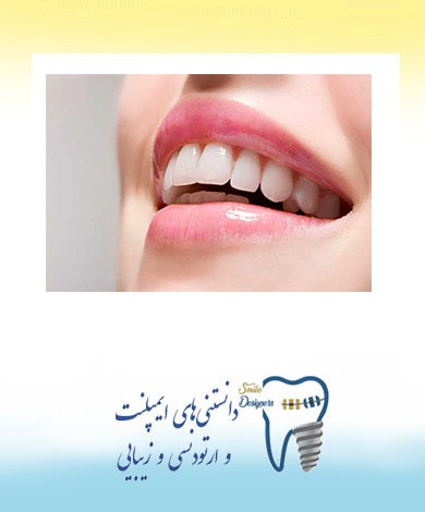 به جای لمینت سرامیکی چه روشهای دیگری وجود دارد؟