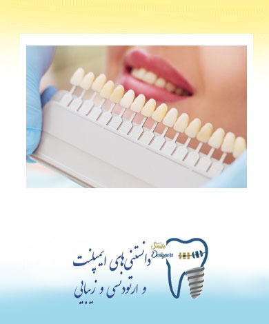 عوامل پنهان تاثیر گذار بر زیبایی لمینت سرامیکی دندان