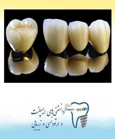 روکش دندان سرامیکی فلزی