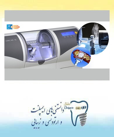 6 نکته و امتیاز ایمپلنت دیجیتالی