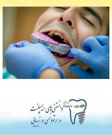 مقایسه قالب گیری دیجیتال با سنتی