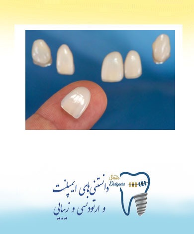 اشتباهات رایج در لمینت کردن دندانها