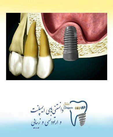 عمل جراحی لیفت سینوس پیش از کاشت ایمپلنت دندان