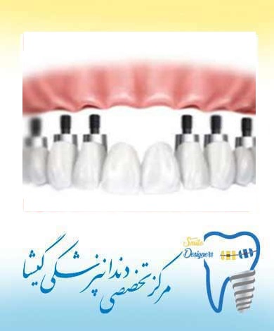 ایمپلنت دندان چیست؟