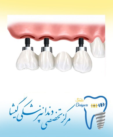 بریج بر پایه ایمپلنت توسط متخصص ایمپلنت در شمال  تهران