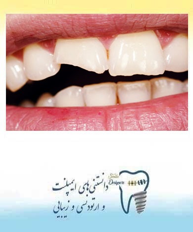 ترمیم و زیبایی دندان لب پر شده یا شکسته