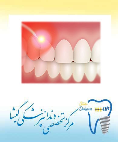 کاربرد لیزر در دندان پزشکی