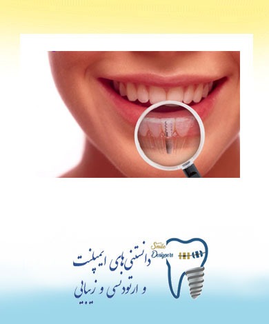 بهترین متخصص ایمپلنت دندان در تهران