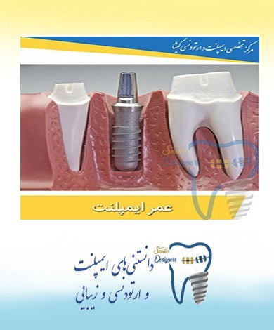 طول عمر ایمپلنت دندان (کاشت دندان)