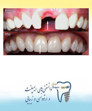ایمپلنت دندان جلو