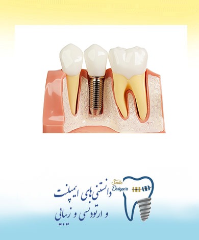 ایمپلنت دندان چیست؟