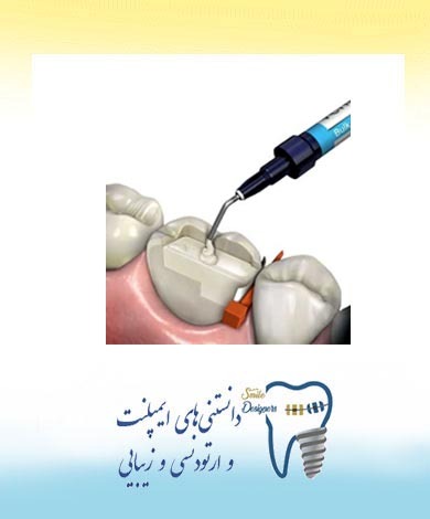 انواع کامپوزیت های در دسترس برای کارهای زیبایی دندان توسط دندانپزشک متخصص زیبایی دندان