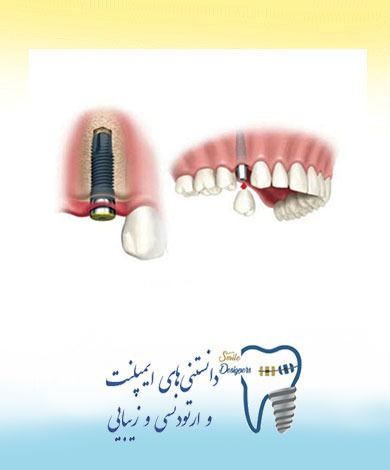 آیا ایمپلنت درد دارد؟