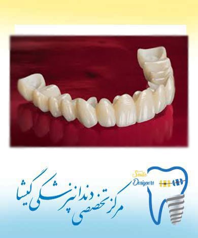 روکش دندان  چیست ؟