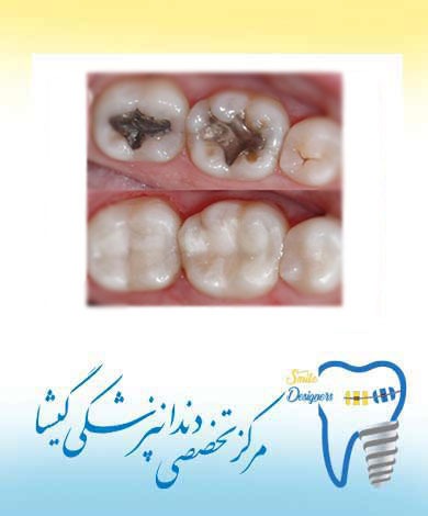 توضیحات متخصص زیبایی دندان در تهران  در مورد لامینیت  کامپوزیت