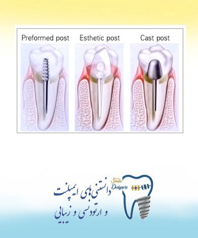 Core و post چیست ؟