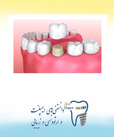 انواع روکش دندان