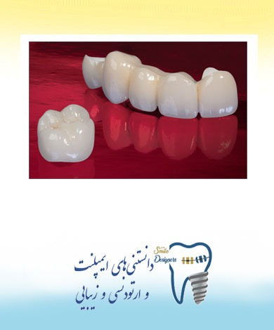 مقایسه روکش تمام سرامیک و PFM ( پرسلن همراه فلز )