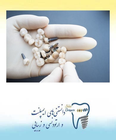 معایب و مزایای روکش کردن دندان