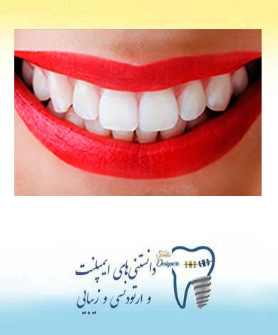 تعویض کامپوزیت رنگ رفته با لمینت دندان