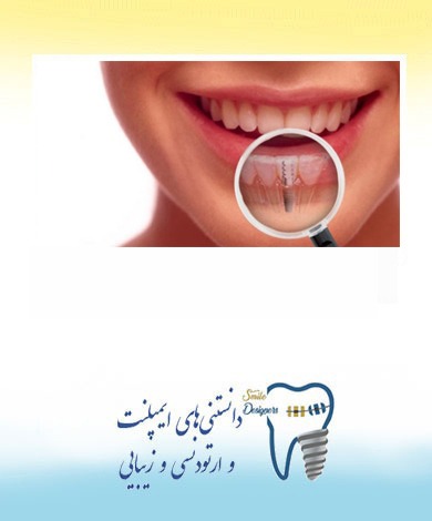 انواع ایمپلنت